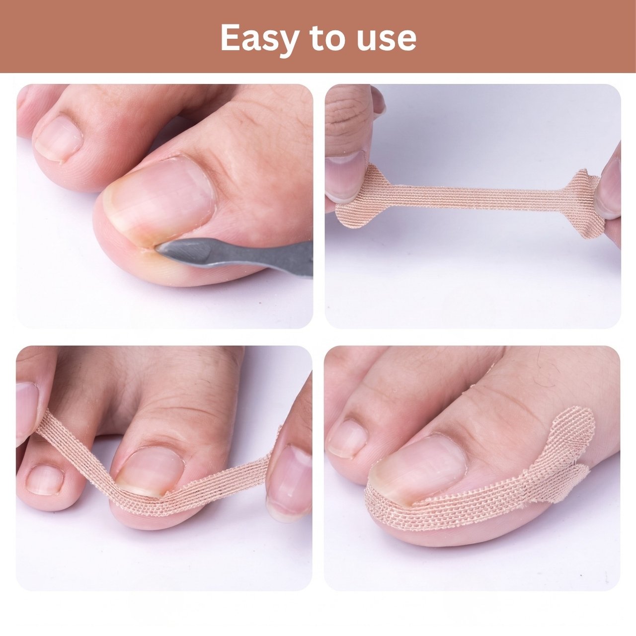 Ingrown Toenail Correction Patches, ProPatches - Image 9